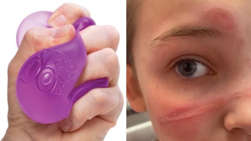 Reto viral con juguete deja niños con quemaduras graves
