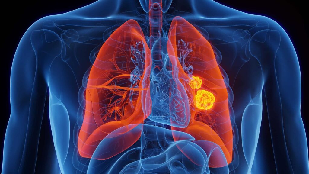Cáncer de pulmón en personas que nunca fumaron: la enfermedad que preocupa cada vez más a los científicos