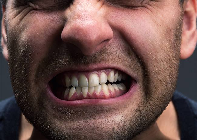 ¿Aprietas los dientes sin darte cuenta? Estas son las señales del bruxismo y cómo tratarlo
