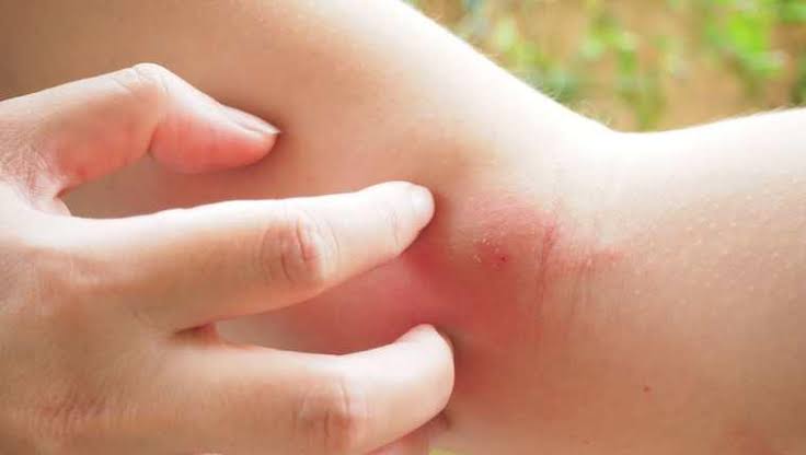 ¿Te despertaste con una marca en la piel? Así puedes saber si fue una picadura de araña mientras dormías